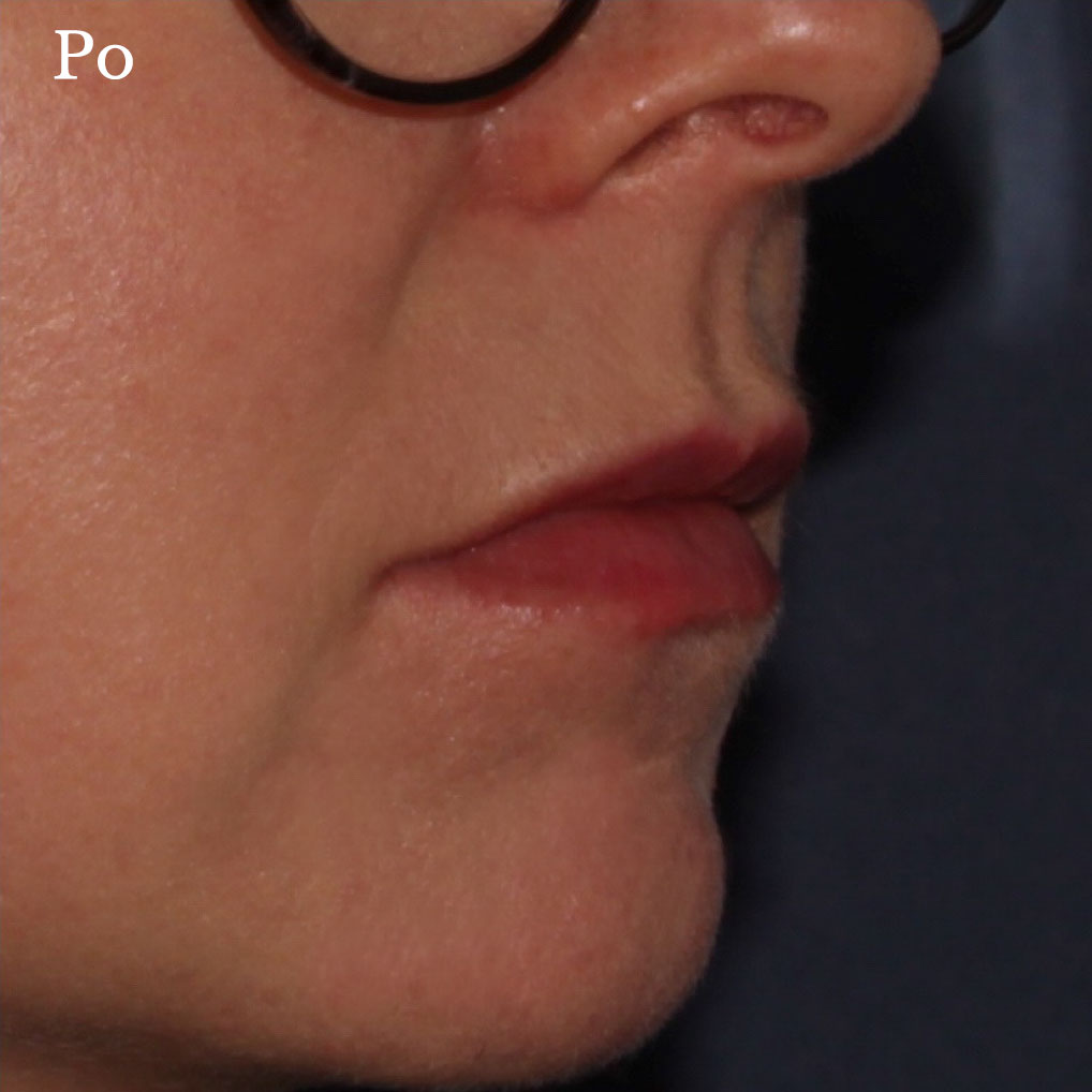 modelowanie ust na płasko katowice- klinika zakrzewscy